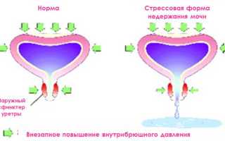 Стрессовое недержание мочи у женщин