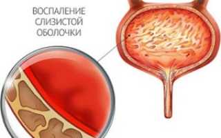 Лучшие средства от женского цистита: отзывы
