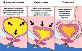 Урологические прокладки для взрослых при недержании мочи