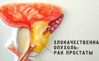 Симптомы рака предстательной железы у мужчин