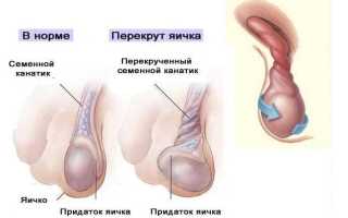 Симптомы болезни яичек у мужчин