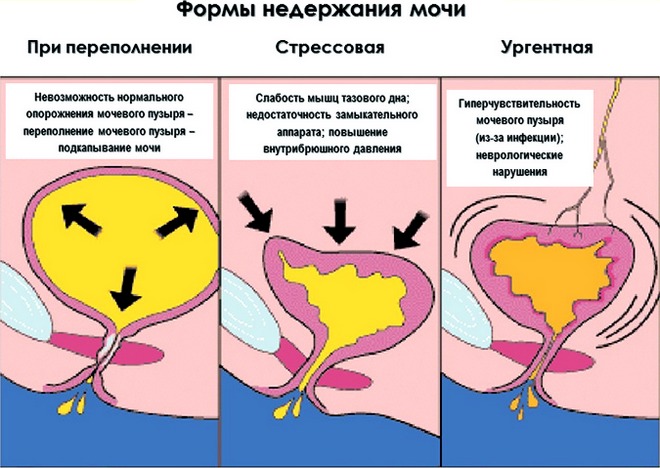 Как выбрать урологические прокладки для женщин