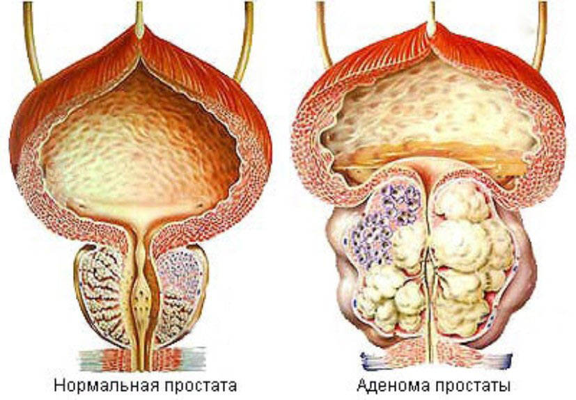 Рак предстательной железы