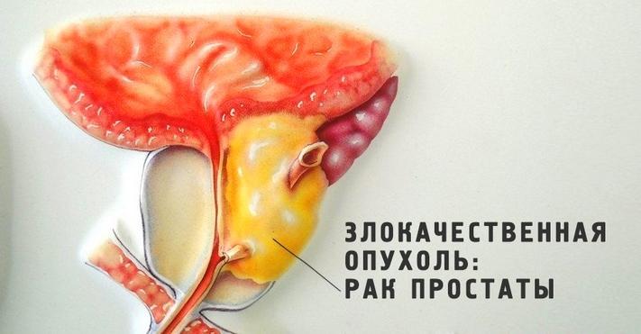 Симптомы рака предстательной железы у мужчин